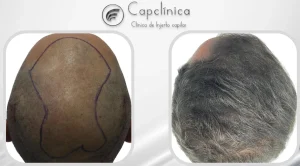 Injertocapilar1